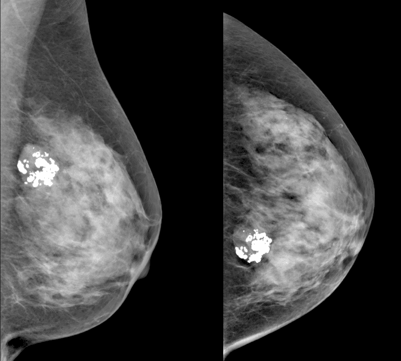NBIA welcomes AI breast radiology study