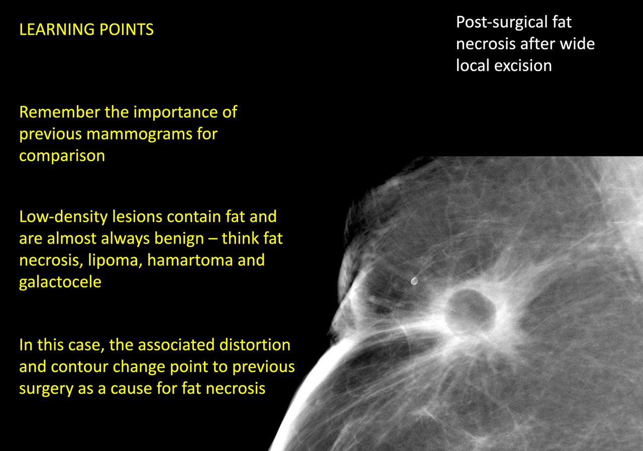 Nightingale FRCR 2B Breast Course goes virtual