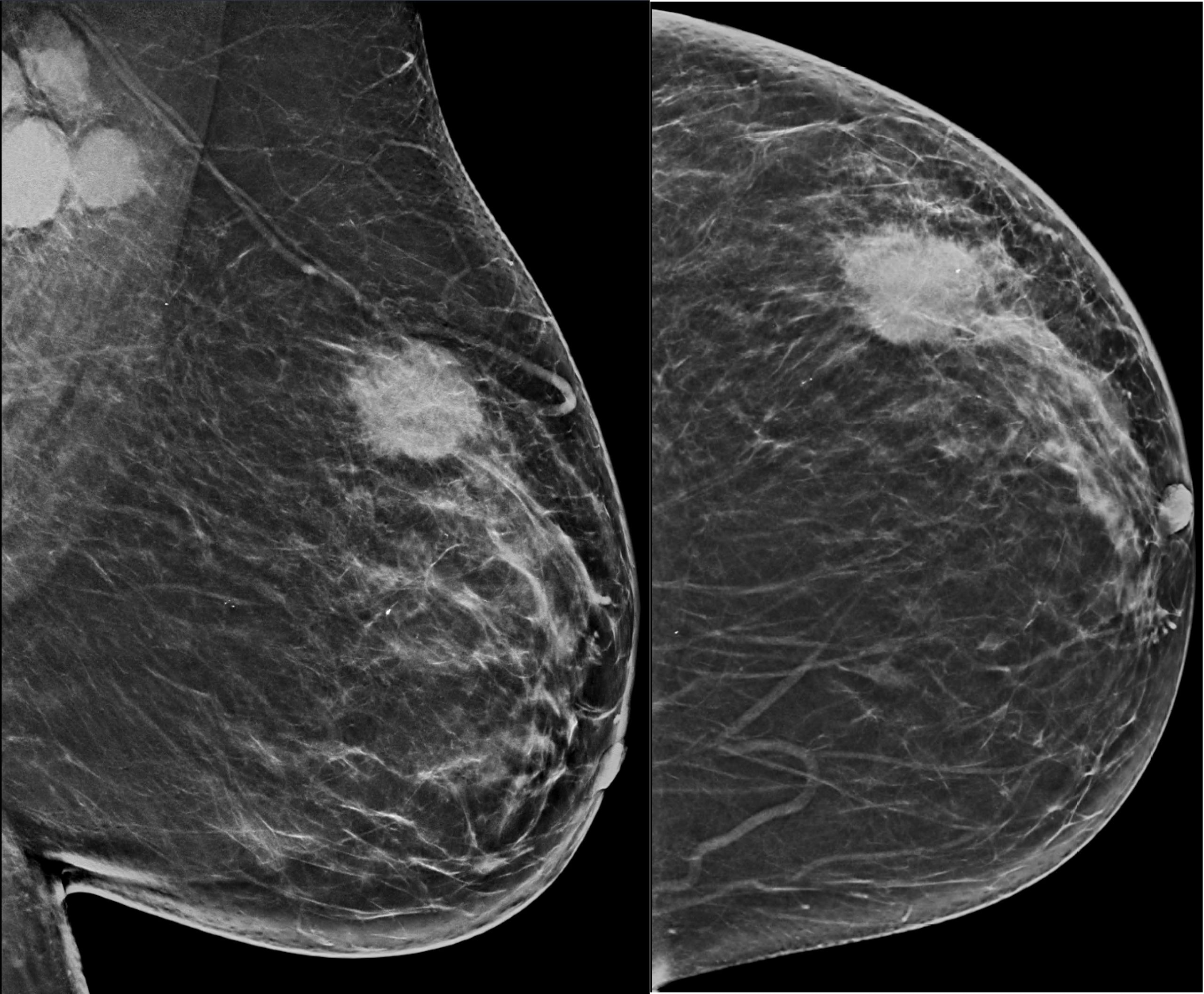 Imaging in Breast Cancer